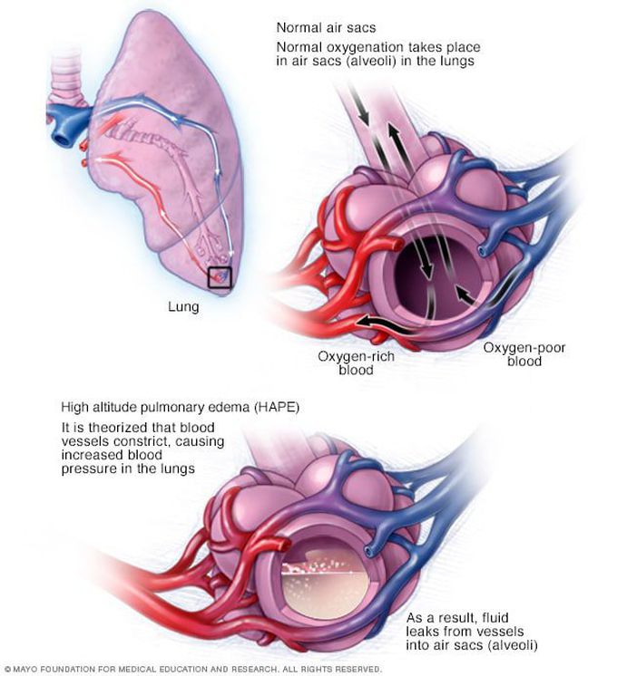 Pulmonary edema causes