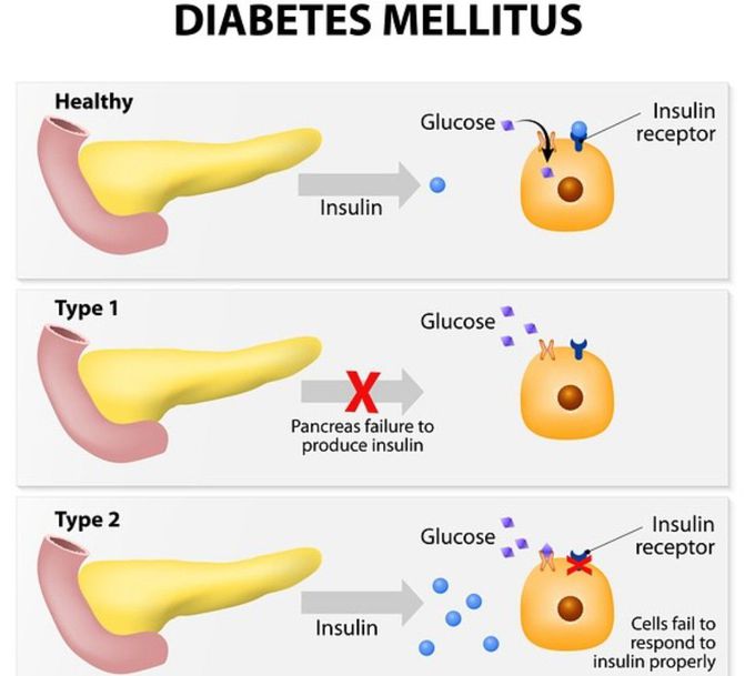 Diabetes Mellitus