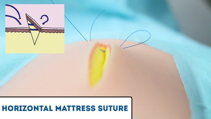Horizontal Mattress Suture - OSCE Guide