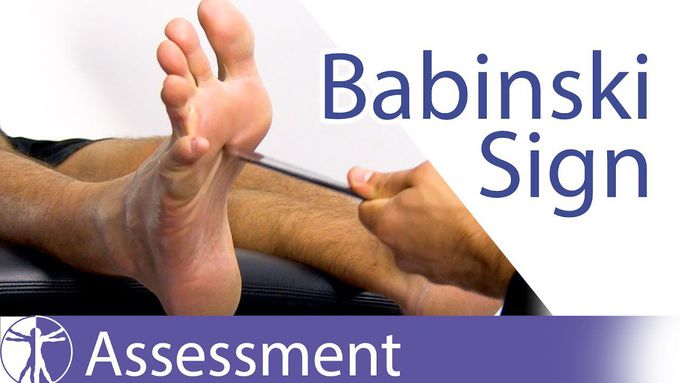 The Babinski Sign and its Significance