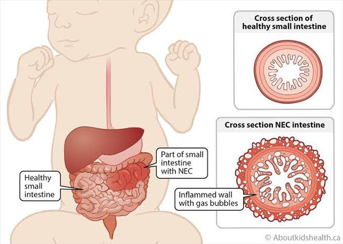 Necrotising enterocolitis