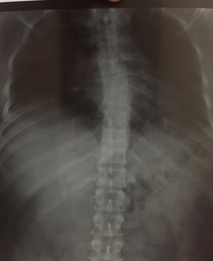 X ray