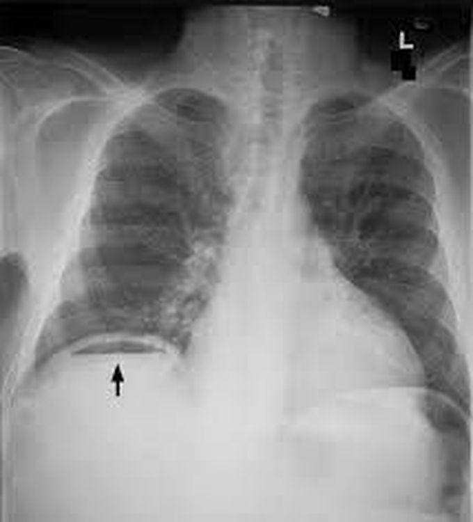 Treatment of pneumoperitoneum