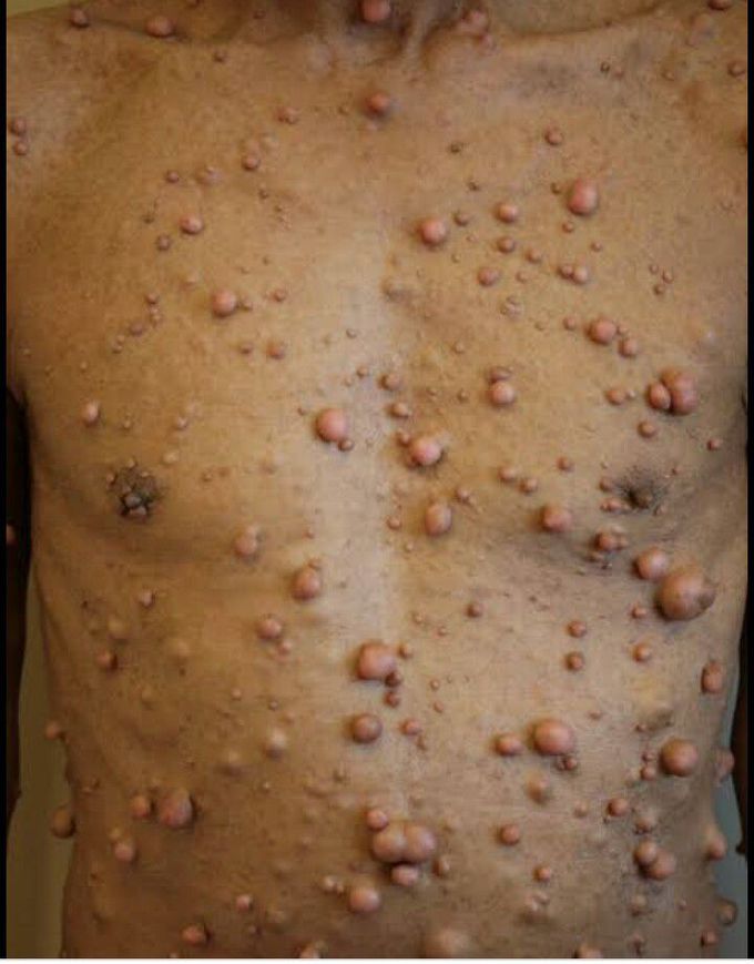 Neurofibromatosis