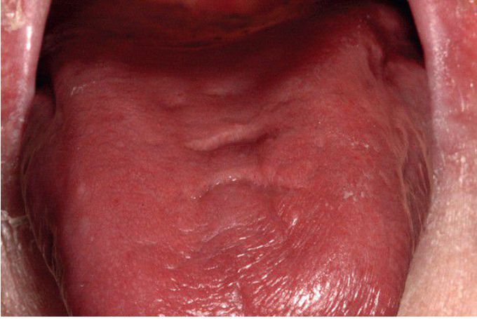 Erythematous Candidiasis