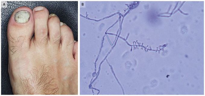 HIV Infection Manifesting as Proximal White Onychomycosis