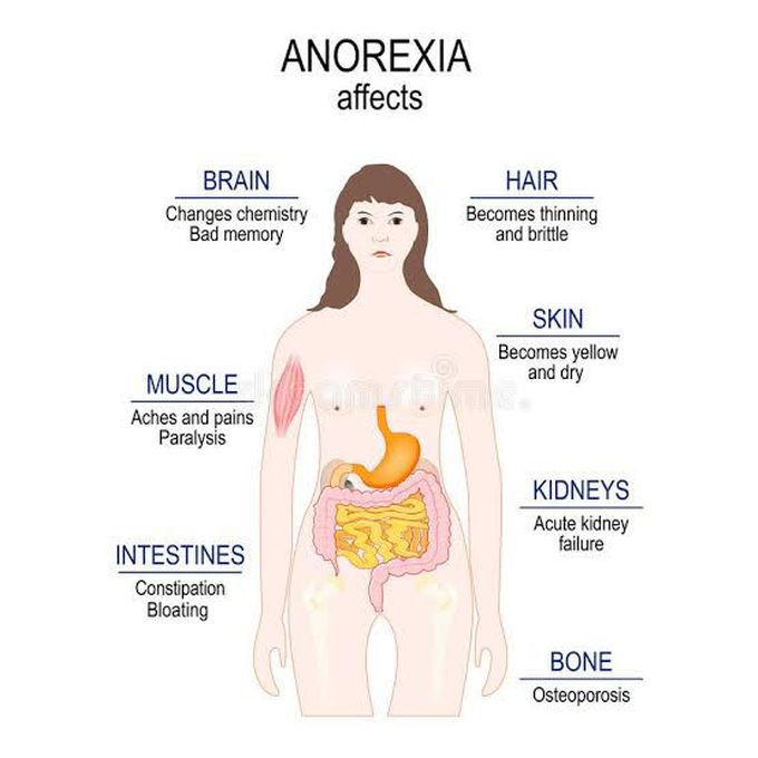 Anorexia Nervosa