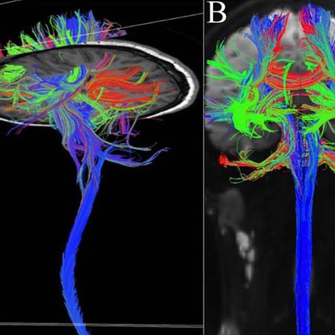 Диффузное пространство. Трактография мрт. Трактография спинного мозга мрт. Трактография головного мозга. Мозолистое тело трактография.
