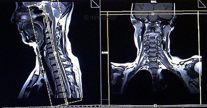 brachial plexus anatomy mri