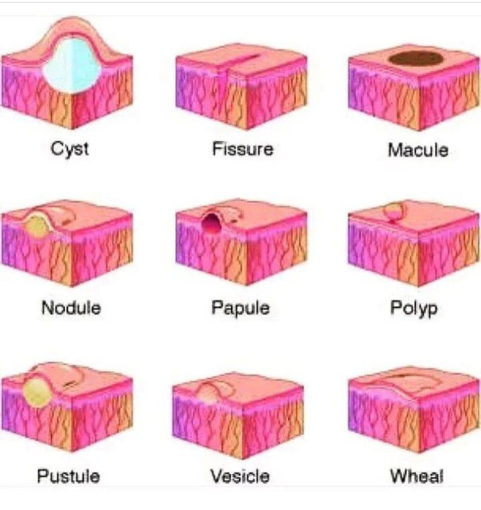 Skin Lesions