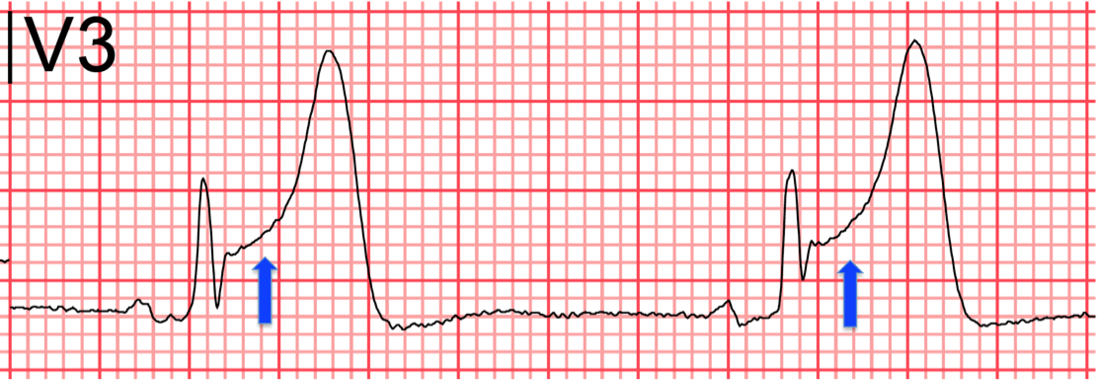 Differential Diagnosis of ST-segment Elevation on ECG - MEDizzy