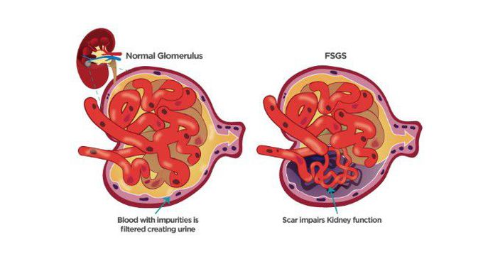 Focal segmental glomerulosclerosis