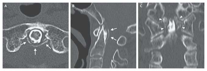 Crowned Dens Syndrome