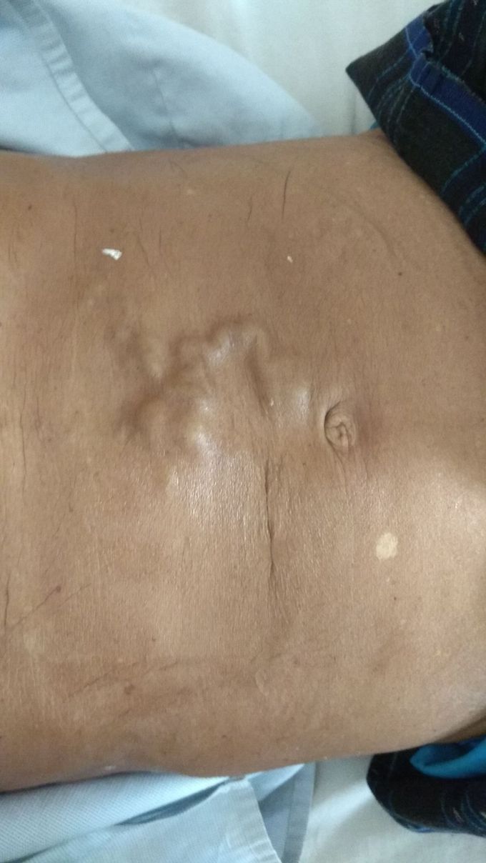 Patient with hepatomegaly and splenomegaly.