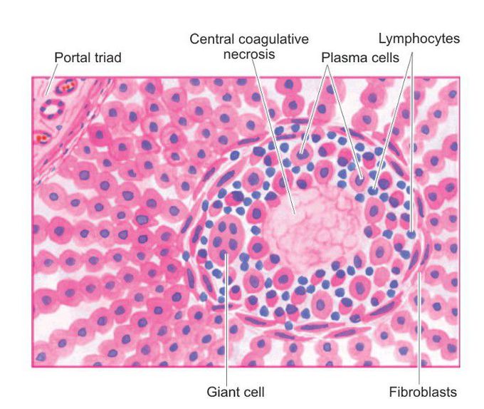 Syphilitic gumma