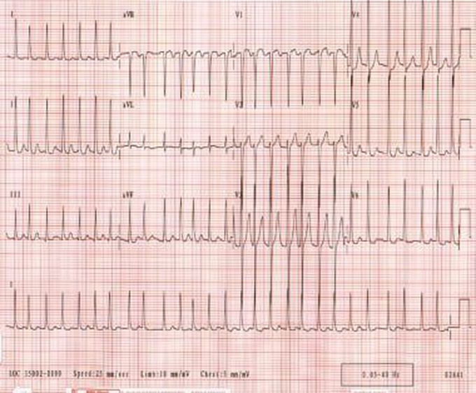 Atrial fibrillation