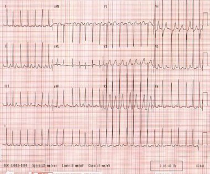 Atrial fibrillation