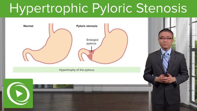 Hypertrophic Pyloric Stenosis