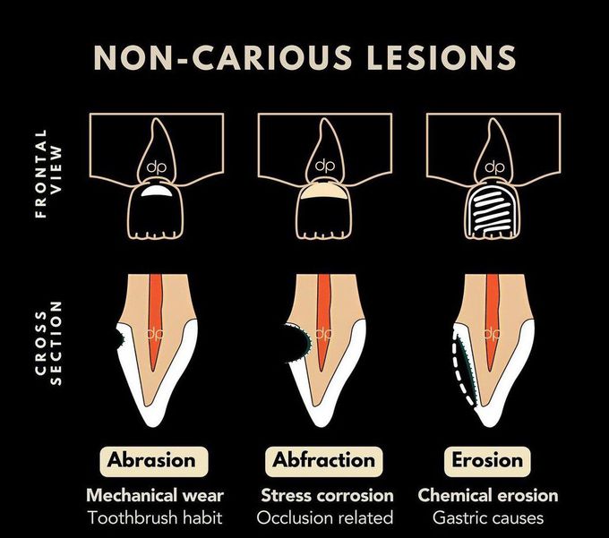 Non Carious Lesions