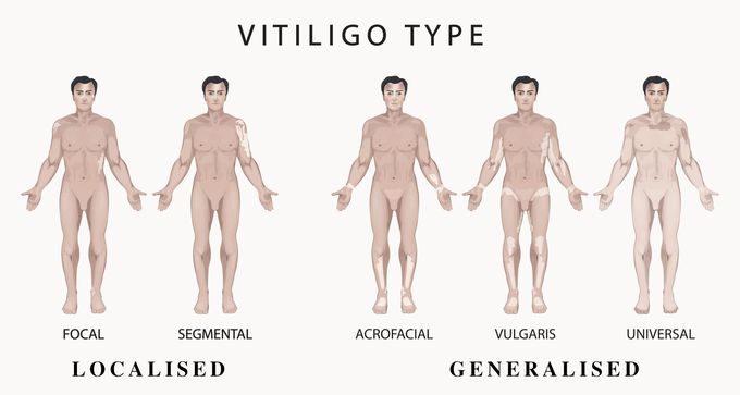 Types of Vitiligo