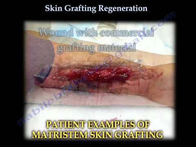 Skin Grafting Regeneration - Everything You Need To Know - Dr. Nabil Ebraheim