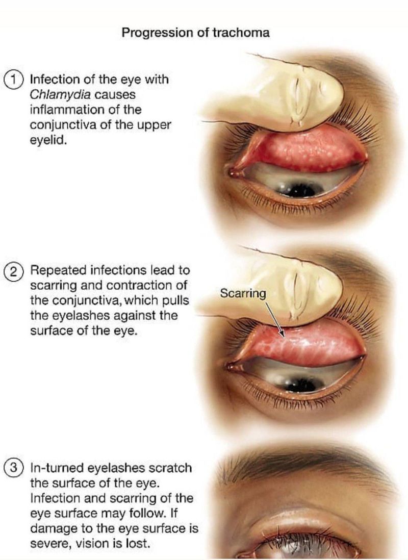 chlamydia in eye