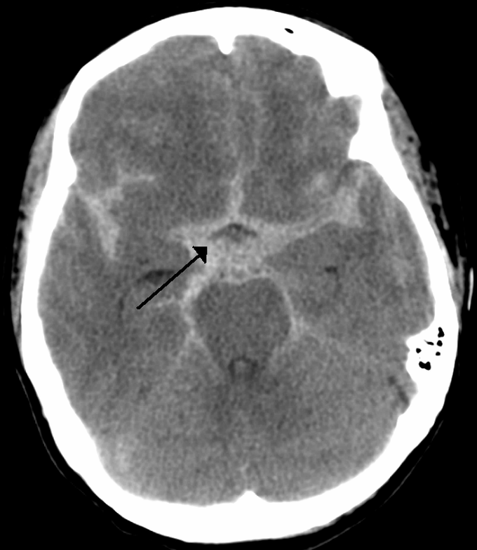 Causes of subarachnoid hemorrhage