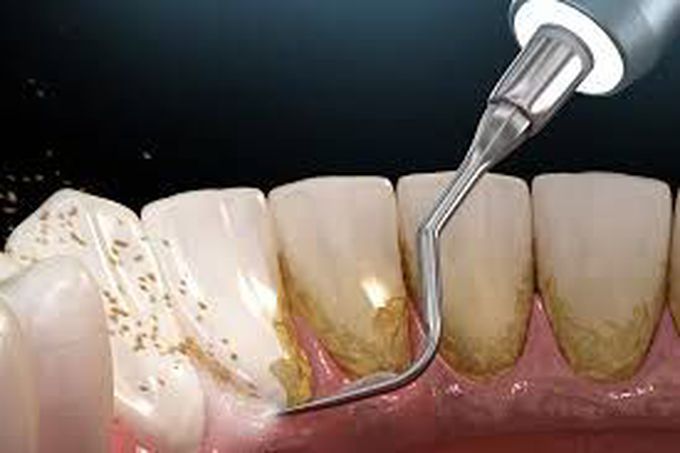 Teeth scaling