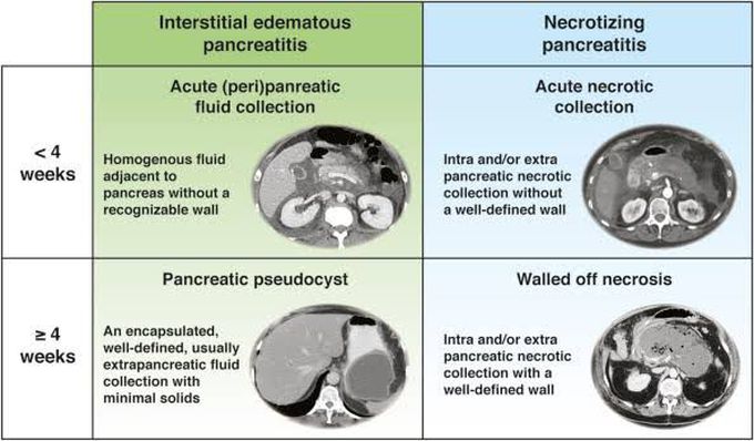 Interstitial Vs Necrotising Pancreatitis