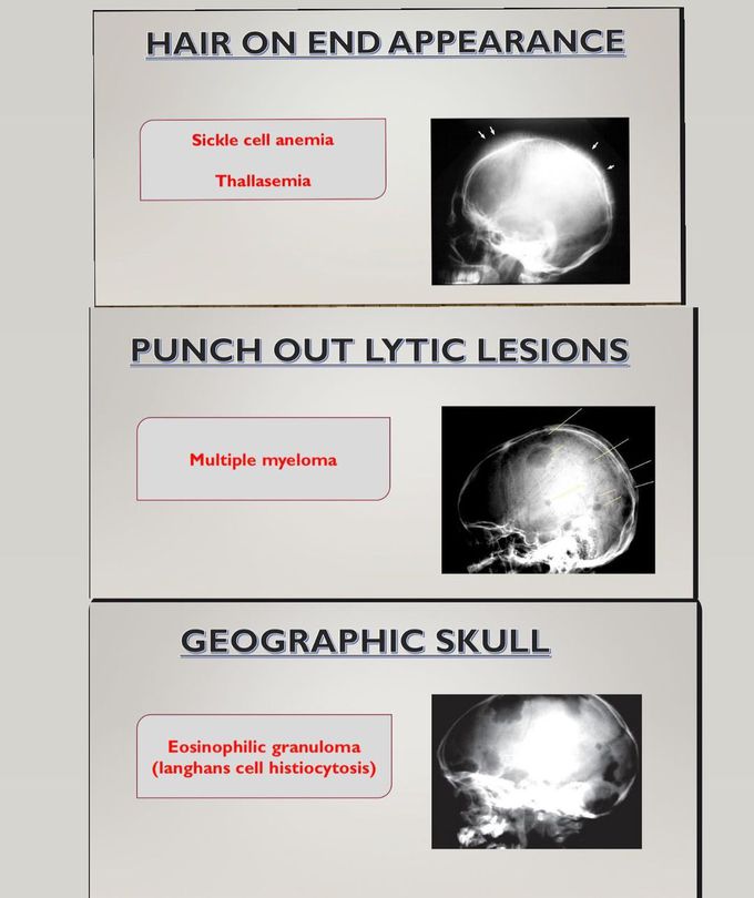 Different Types of Skull Radiograph