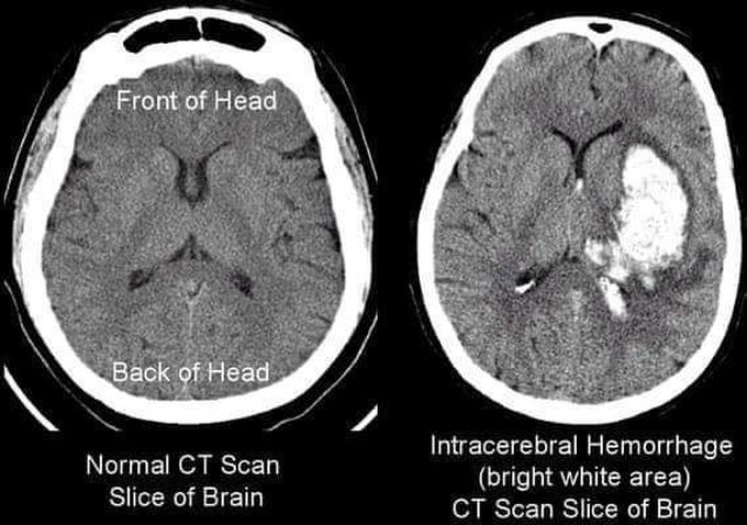 Your Consultant shows you a CT scan head during your rotation in the neurosurgery ward with findings as given above. What is your most likely diagnosis?