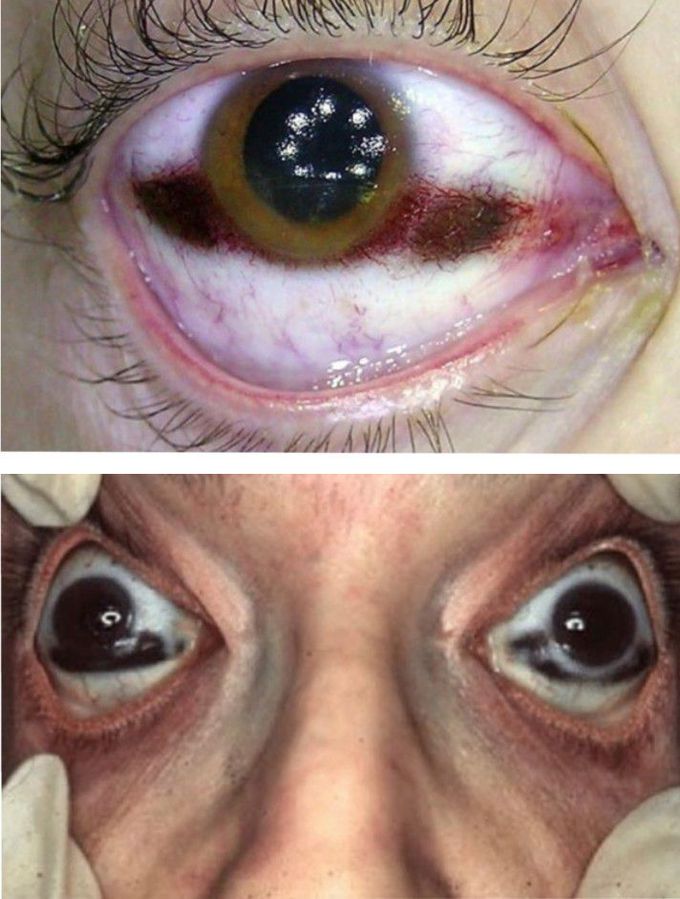 The eyes after death