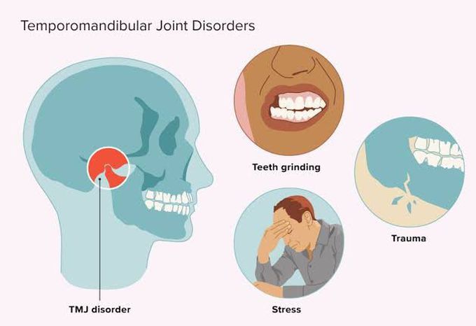 TMJ disorders