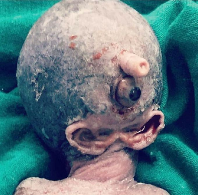 🧬🧬Patau syndrome🧬🧬