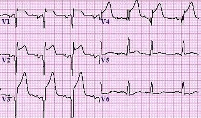 ECG changes in acute MI