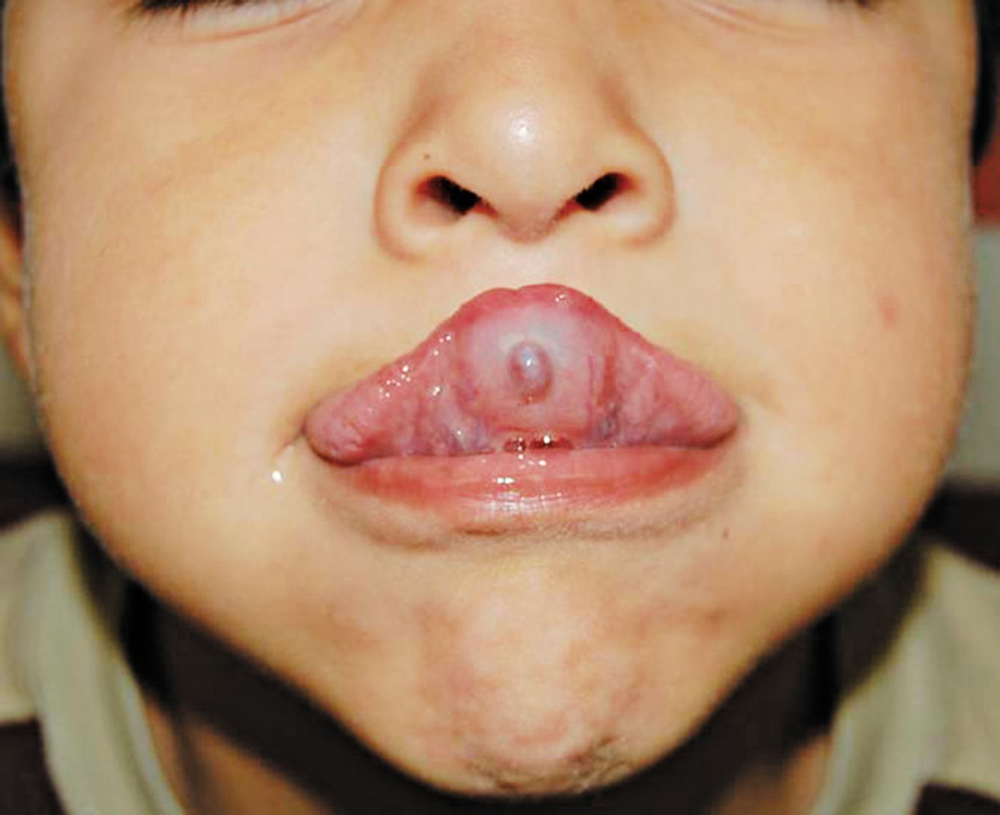 mucocele under tongue