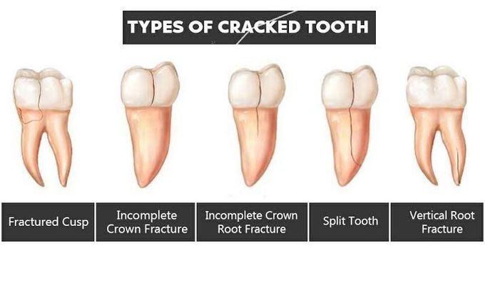 Types of cracked tooth