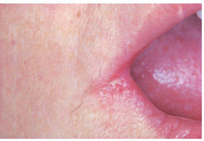 Angular stomatitis