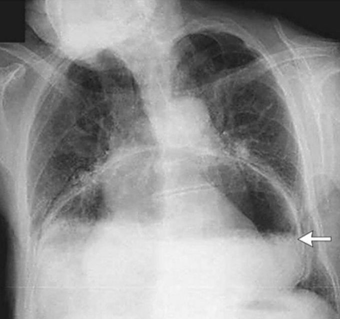 What is ur diagnosis ??