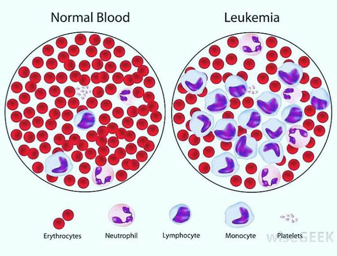 Normal blood vs lukemia