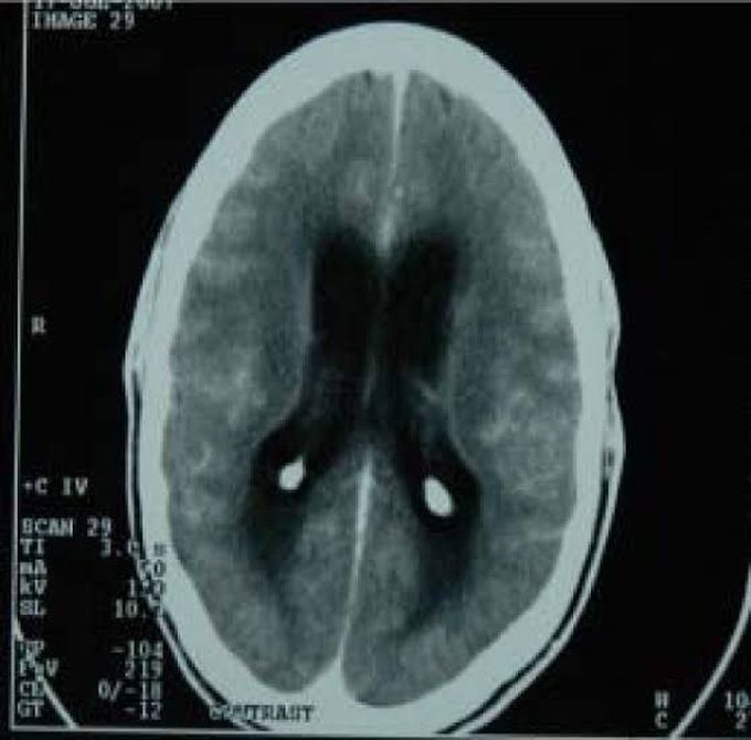 Tuberculous Meningitis