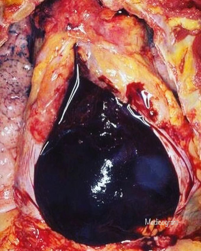 Hemopericardium