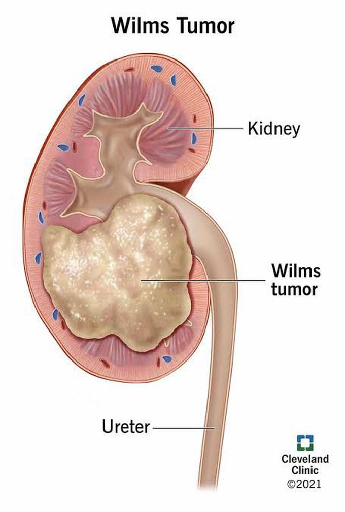 Treatment of wilms tumor