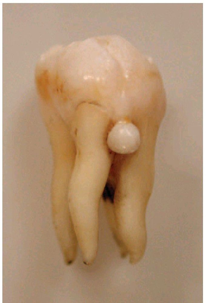 Enamel pearl