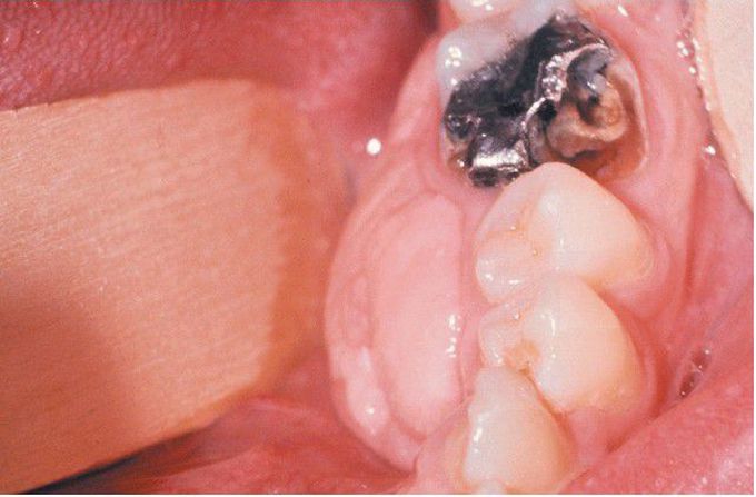 Fibromatosis