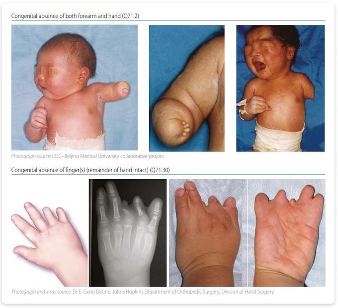 Congenital malformations