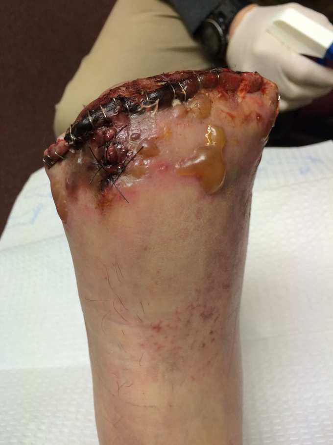 Management Of Crush Injuries Of The Foot