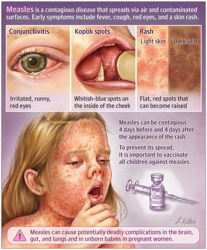 Measles