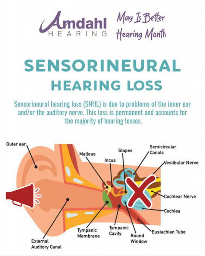 Sensorineural deafness