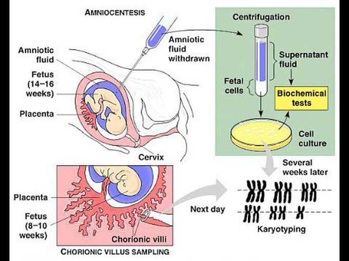 Amniocentesis & Chorionic Villus Sampling - A Comparison